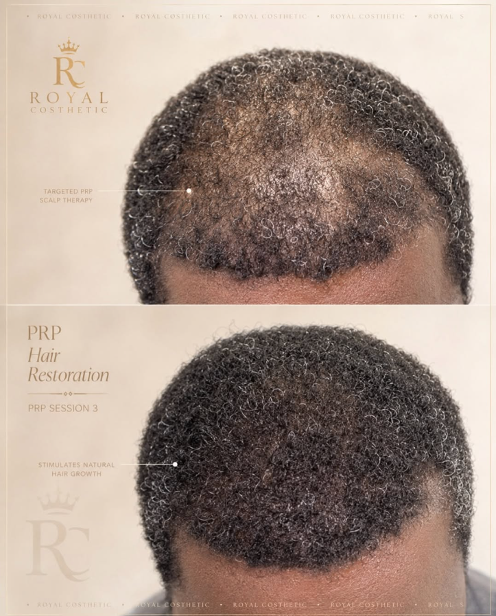 PRP Hair Restoration