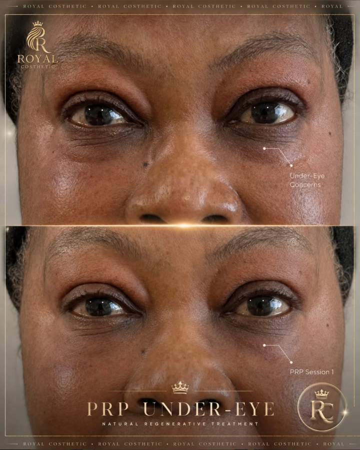 PRP Microneedling